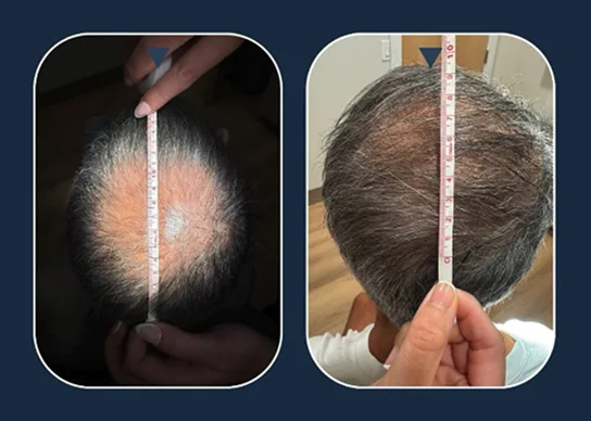 Hair Restoration & Scalp Revitalization